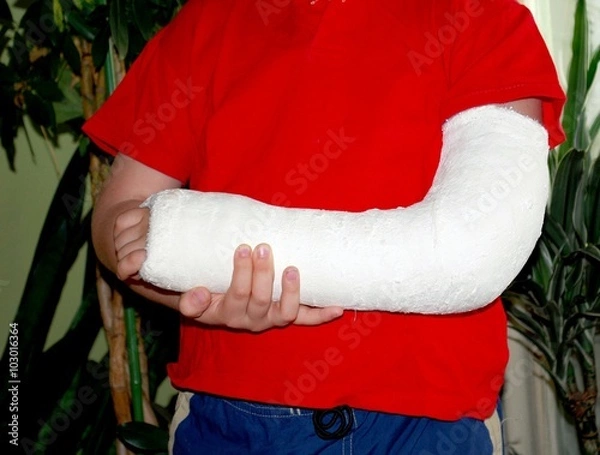 Fototapeta hand in a cast