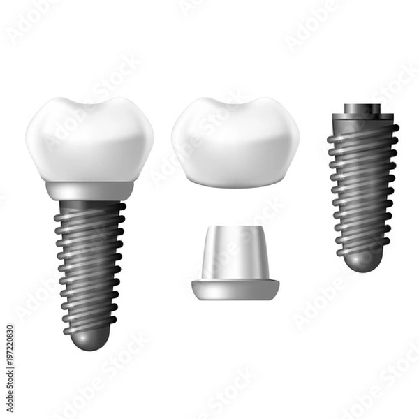 Obraz Component parts of dental implant - teeth denture