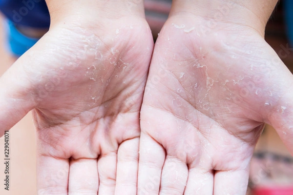 Fototapeta close up boy's hand skin peeling due