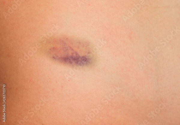 Fototapeta Close up Bruises mark from accident