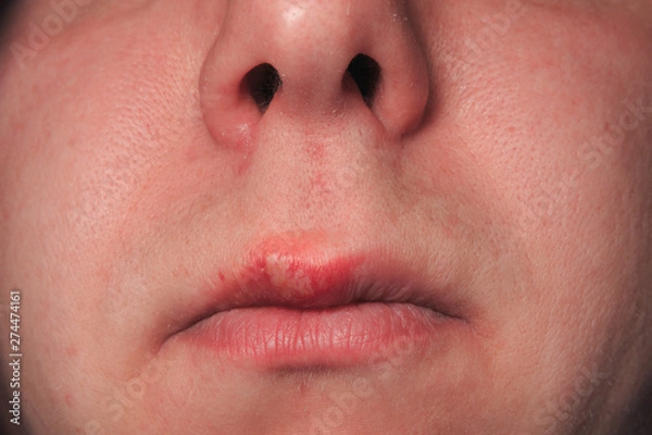 Fototapeta Second day of growing herpes on caucasian male man on front upper lip