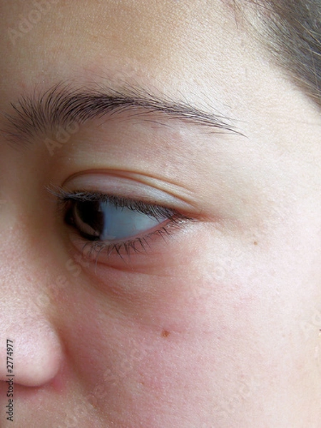 Fototapeta girl with swollen eye / crying / allergy