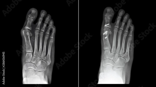 Obraz Compare between before and after surgery. Film x-ray foot radiograph show Hallux valgus deformity or Bunion disease which treatment by corrective osteotomy fixation. Medical technology concept 