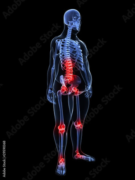 Fototapeta übergewichtige Mann - markierte Wirbelsäule und Gelenke