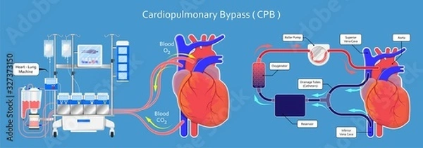 Fototapeta Cardiopulmonary bypass heart lung machine coronary oxygenator perfusiologist cardiologist operating life support artery graft circulation repair mitral tricuspid pulmonic septal defect aneurysms aid