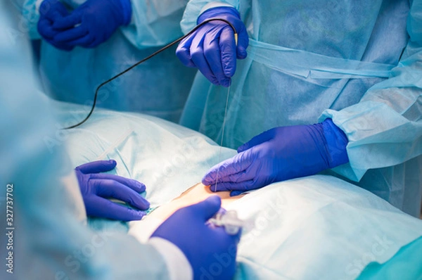 Fototapeta hands in blue gloves in the operating room during minimally invasive surgery,