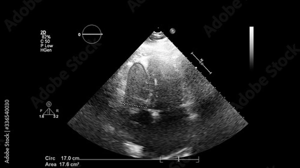 Fototapeta Image of the heart in gray-scale mode during transesophageal ultrasound.