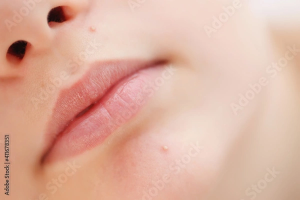 Fototapeta Teenage acne on the chin. Close up face with pimple. Teen problem. High quality photo.