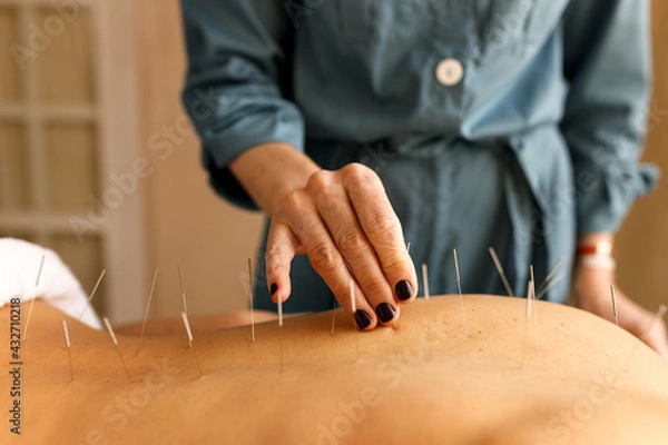 Fototapeta Close up image of female hand sticking fine acupuncture needle to strategic trigger points on patient’s back. Traditional Chinese medicine, treatment, health, therapy and wellness concept