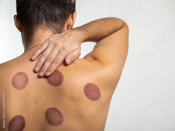 Fototapeta a man with neck pain. traditional medicine. traces of processing with cans on the back