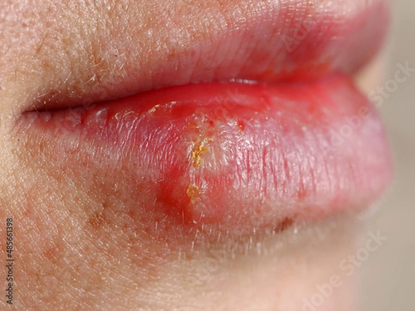 Fototapeta herpes on the lip of a woman