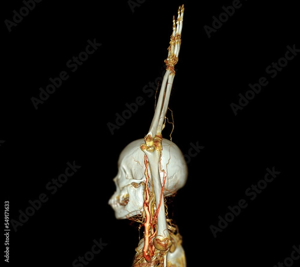 Fototapeta Brachial Arteries of the arm with Upper extremity Bone 3D rendering from CT Scanner.