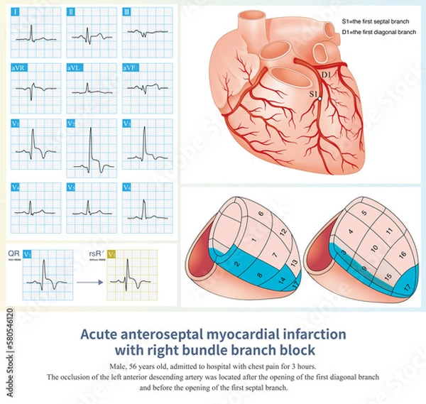 Obraz Counterclockwise rotation is a common ECG phenomenon, which is partly a simple ECG phenomenon, and partly related to left ventricular hypertrophy caused by disease.