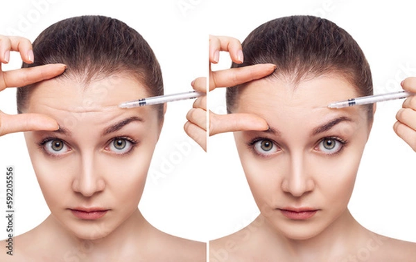 Fototapeta Woman before and after injections to smooth mimic wrinkles.