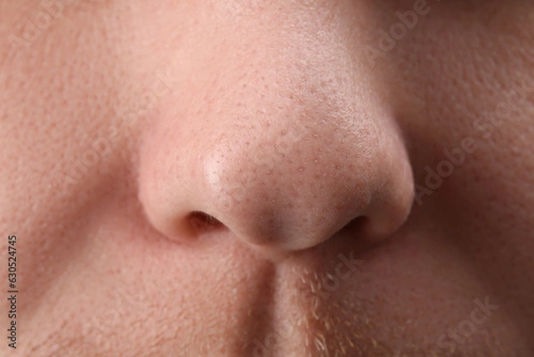 Fototapeta Young man with acne problem, closeup view of nose