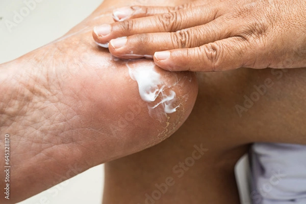 Fototapeta Woman care feet with cracked and dry heel skin cream at home.