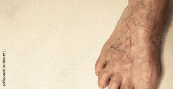 Fototapeta Veins on the legs. Varicose veins on the leg of an elderly woman.